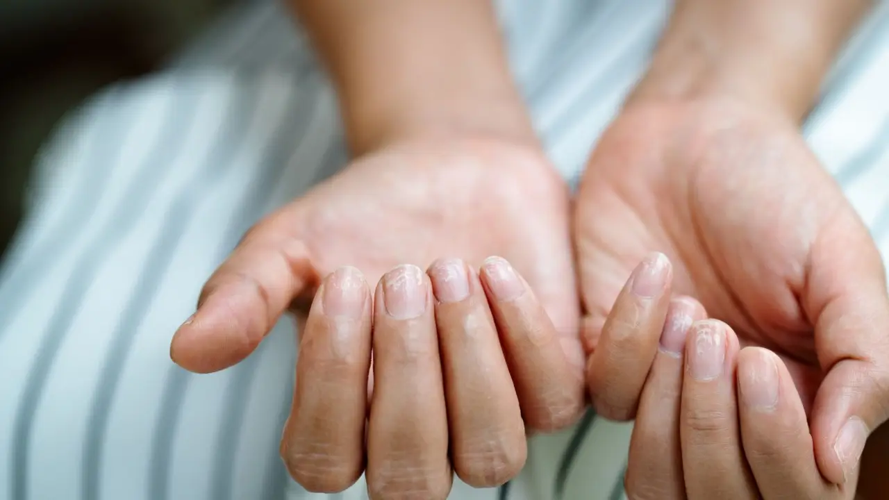 Micosi? Unghie malate o che si spezzano? Ecco cosa rivela sulla tua salute e come curarle